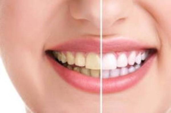 چگونه با روش بلیچینگ می توان دندان را سفید کرد؟