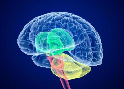 فلج مغزی چیست و چه نشانه هایی دارد؟